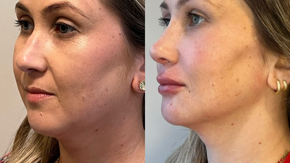 Before and after — Jessica T.