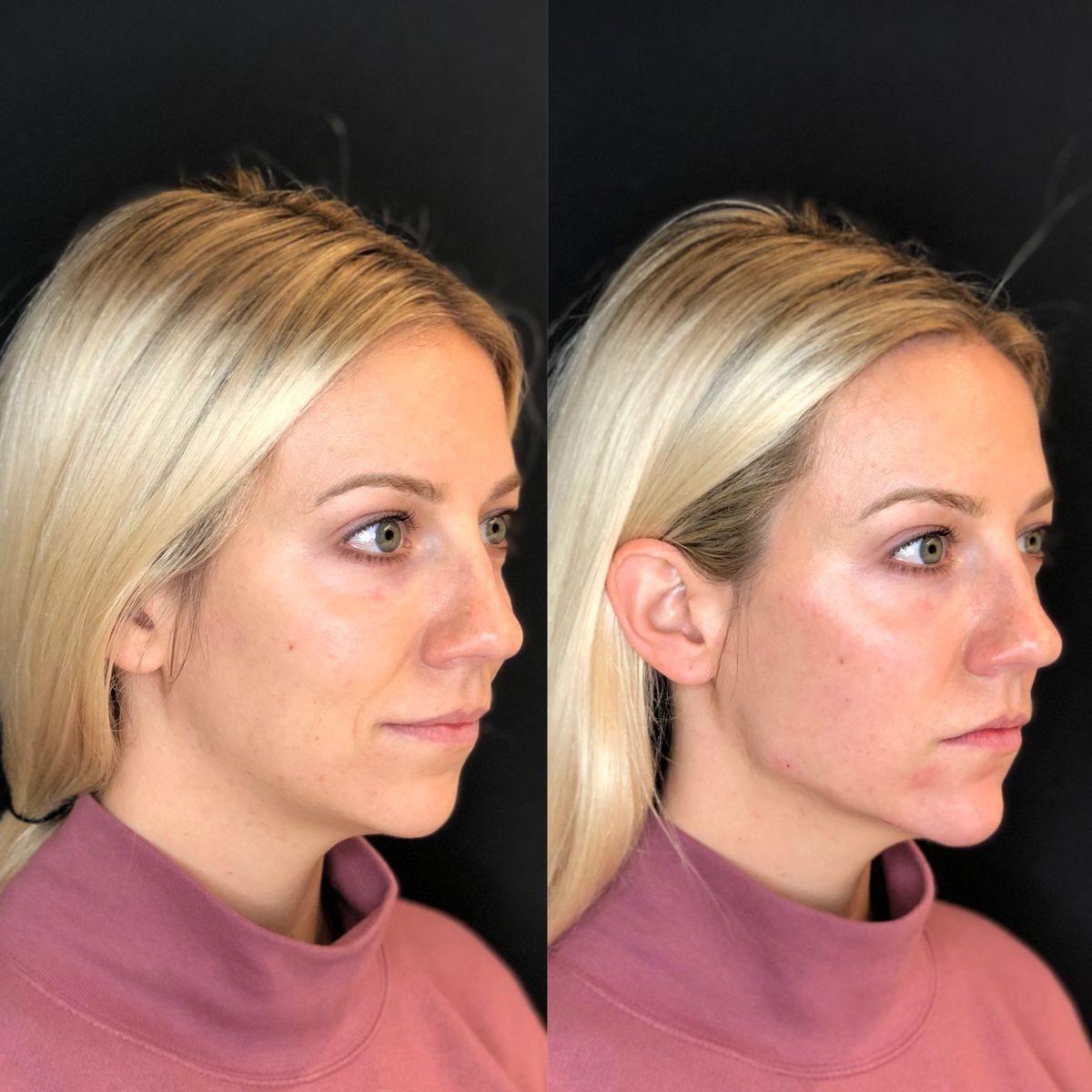 Before and after — Sarah M.