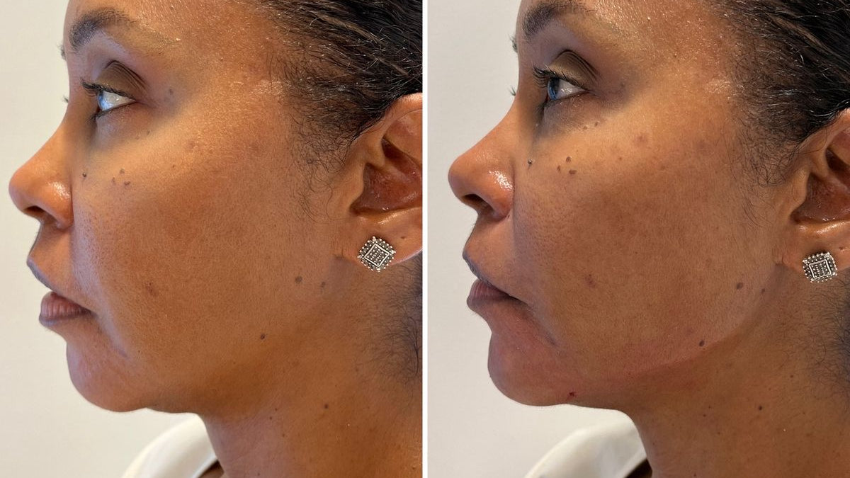 Before and after — Pilar R.